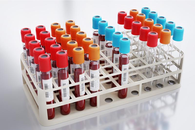 Exame de sangue simples pode indicar risco de Alzheimer anos antes dos sintomas, aponta estudo; entenda